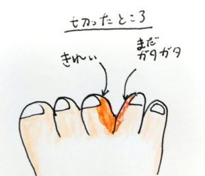 合指症