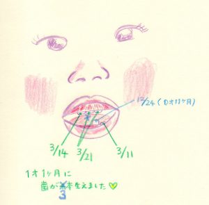 ダウン症