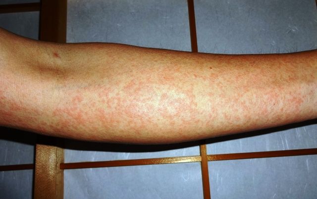 薬疹がぶり返した : 素晴らしきロード人生