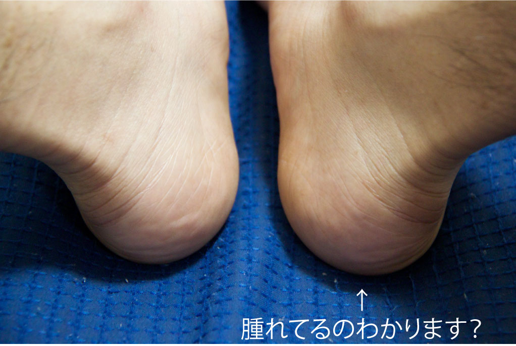 診断結果 足底筋膜炎 おまけで 三分裂種子骨 でした 安物靴には注意ですよ レスペス トランクィル