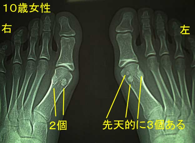 診断結果 足底筋膜炎 おまけで 三分裂種子骨 でした 安物靴には注意ですよ レスペス トランクィル 診断結果 足底筋膜炎 おまけで 三分裂種子骨 でした 安物靴には注意ですよ レスペス トランクィル