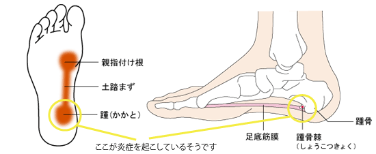 診断結果 足底筋膜炎 おまけで 三分裂種子骨 でした 安物靴には注意ですよ レスペス トランクィル