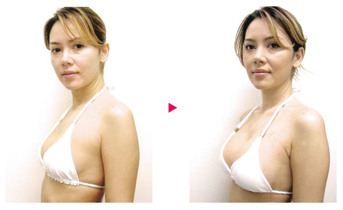 20代女性 産後萎んだ胸を豊胸 モティバ340cc 1ヶ月後 症例写真 美容整形 美容外科なら聖心美容クリニック