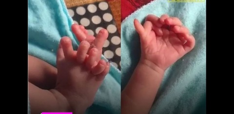 【画像】インドで手足に合計26本の指を持つ赤ちゃんが誕生、女神の生まれ変わりだと話題に