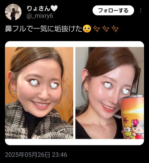 【画像】女性さん、鼻の整形で一気に垢抜けるｗｗｗｗｗｗｗｗｗｗ