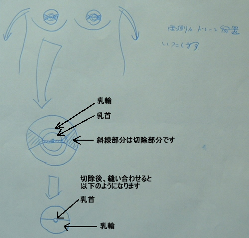 胸オペ日記 １ 入院編 Rｅａｌ ｈｅａｒｔ