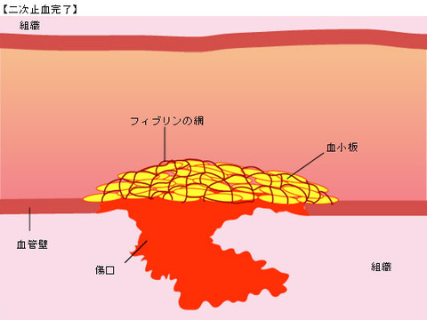 hemophilia_09_con02_02