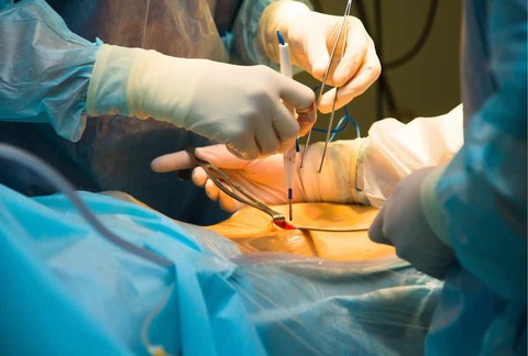 handheld-retractor-surgery