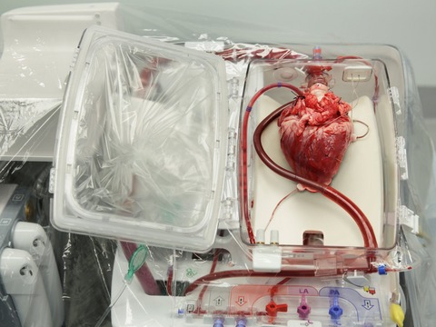 08-26-gsorgantransplants-01