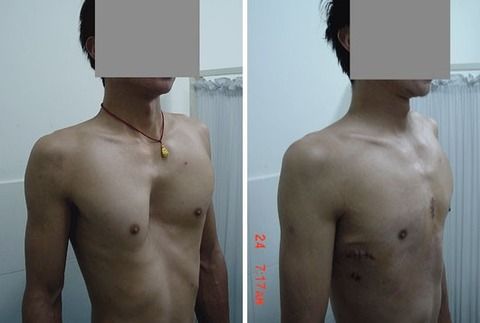 ソラリスの島 漏斗胸の男子