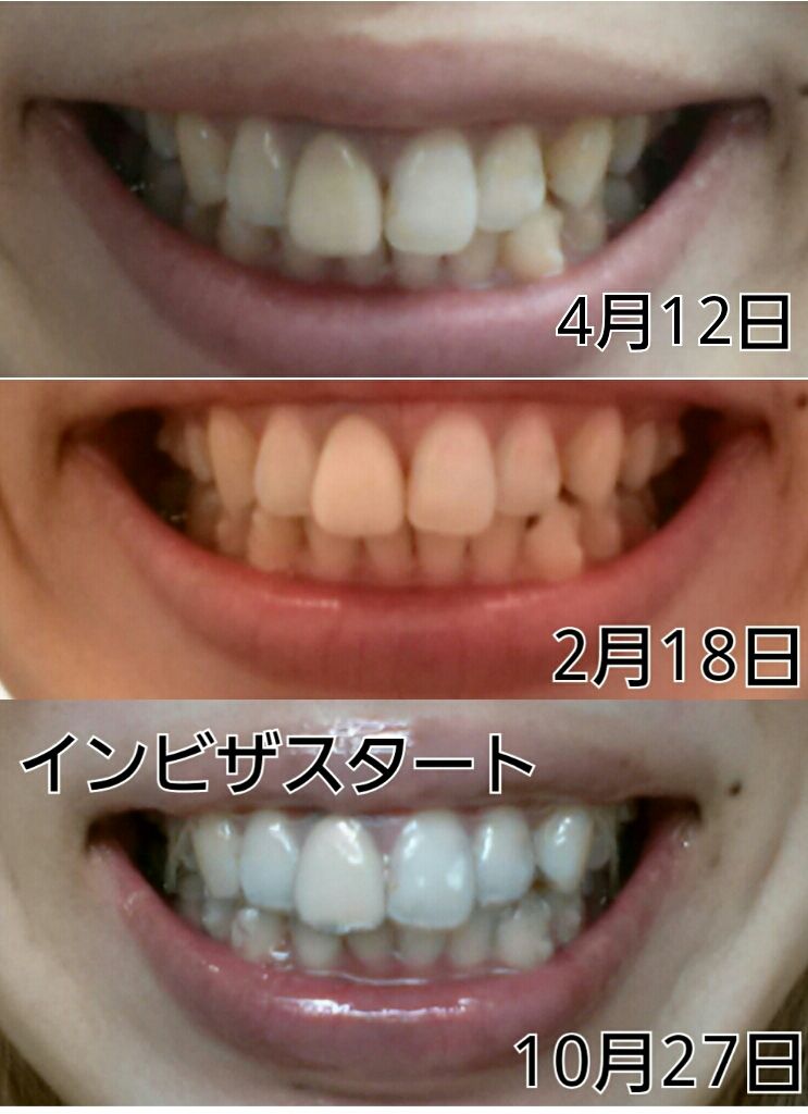 経過 写真あり リスこの歯科矯正ブログ