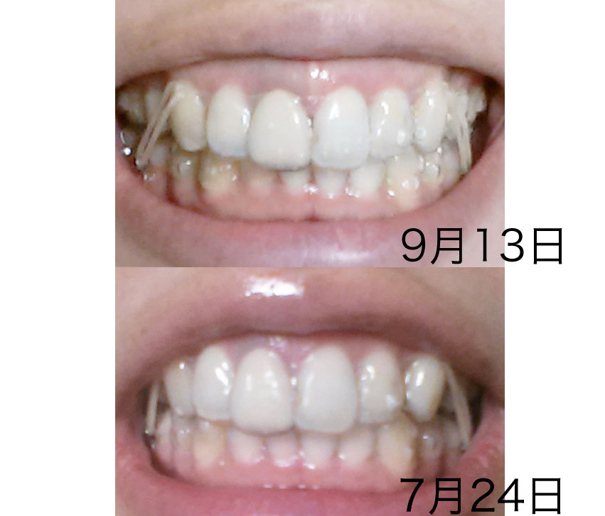 経過 写真あり リスこの歯科矯正ブログ