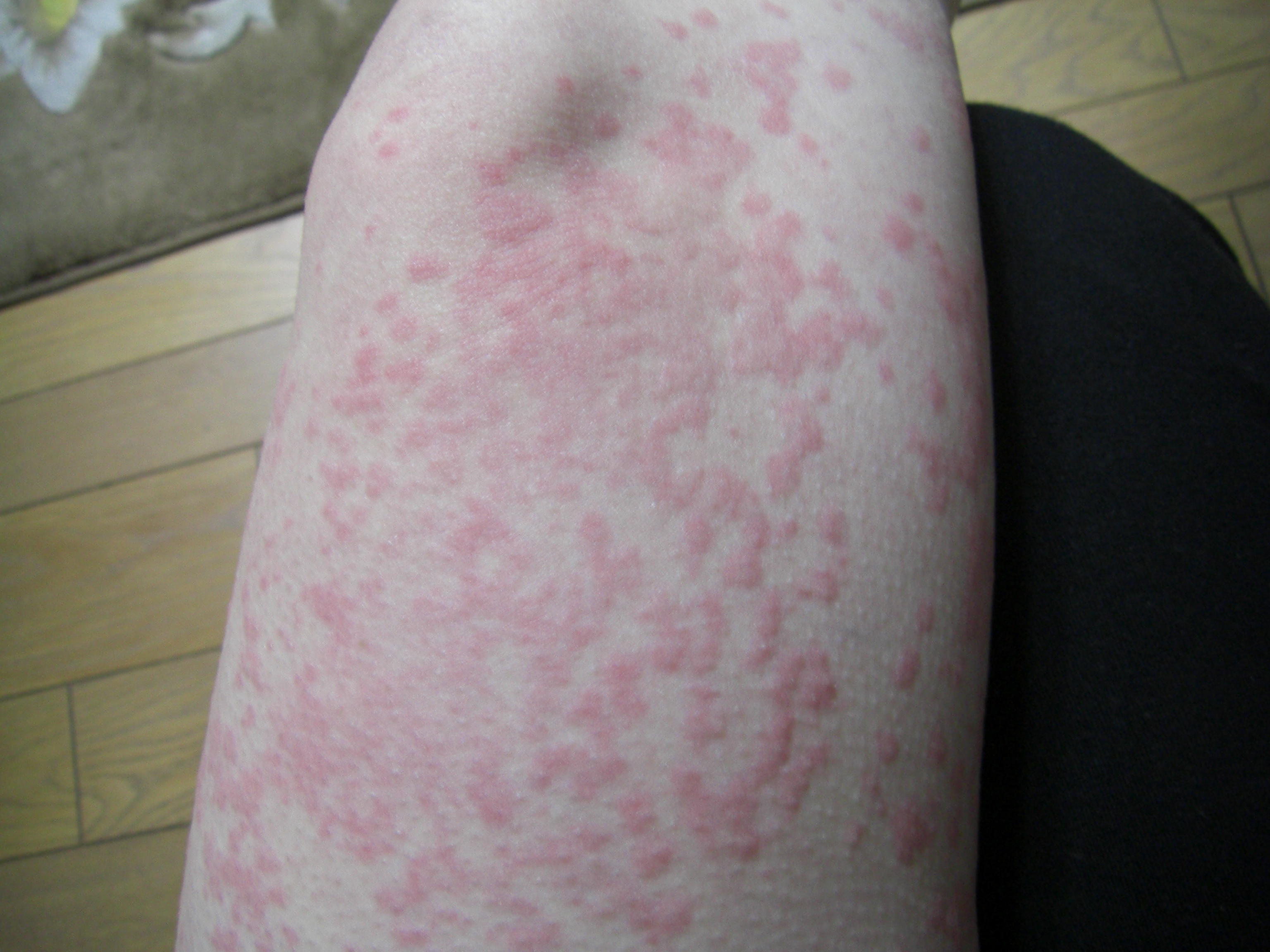 時間差攻撃 コリン性蕁麻疹