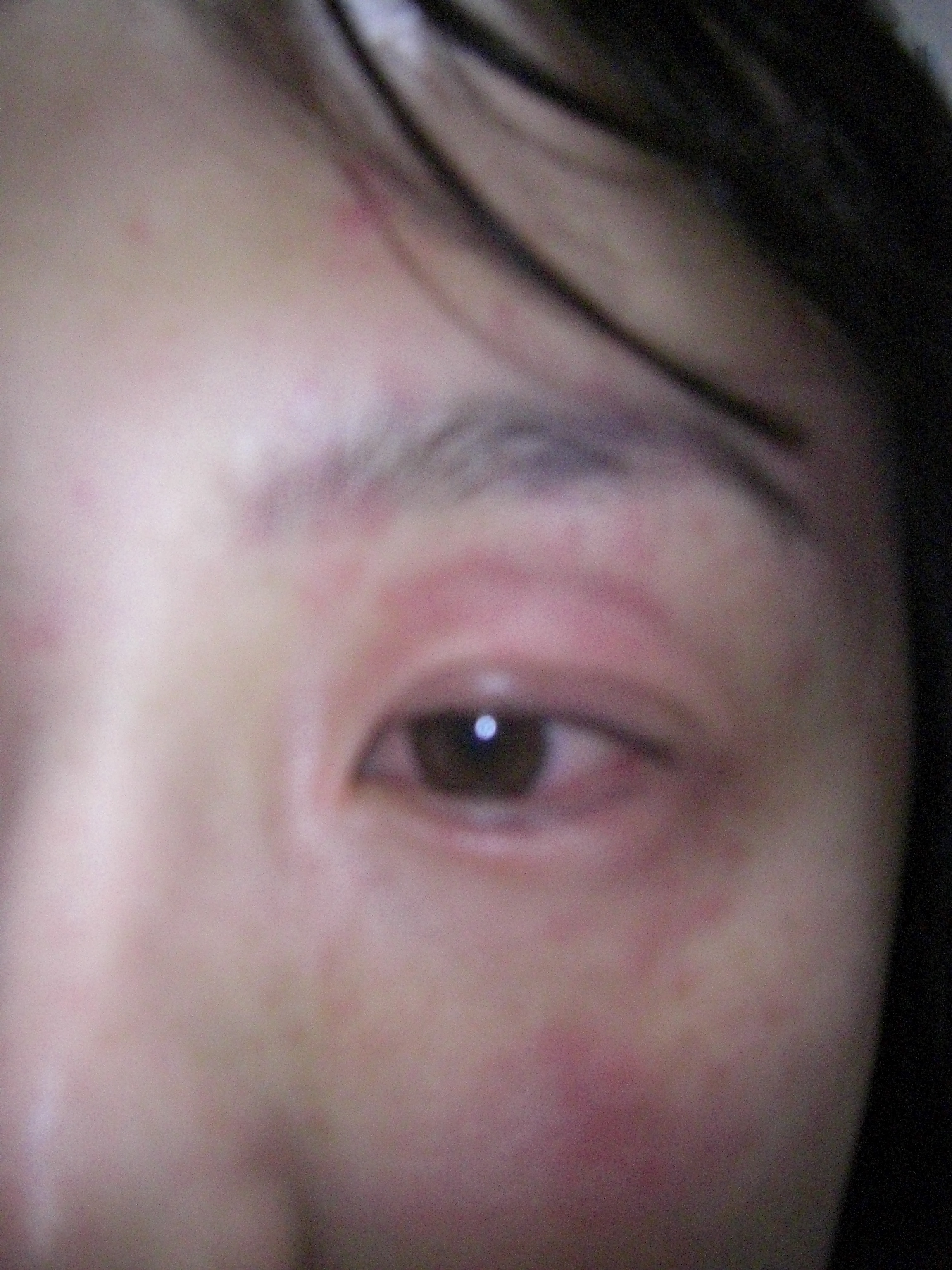 熱 コリン性蕁麻疹