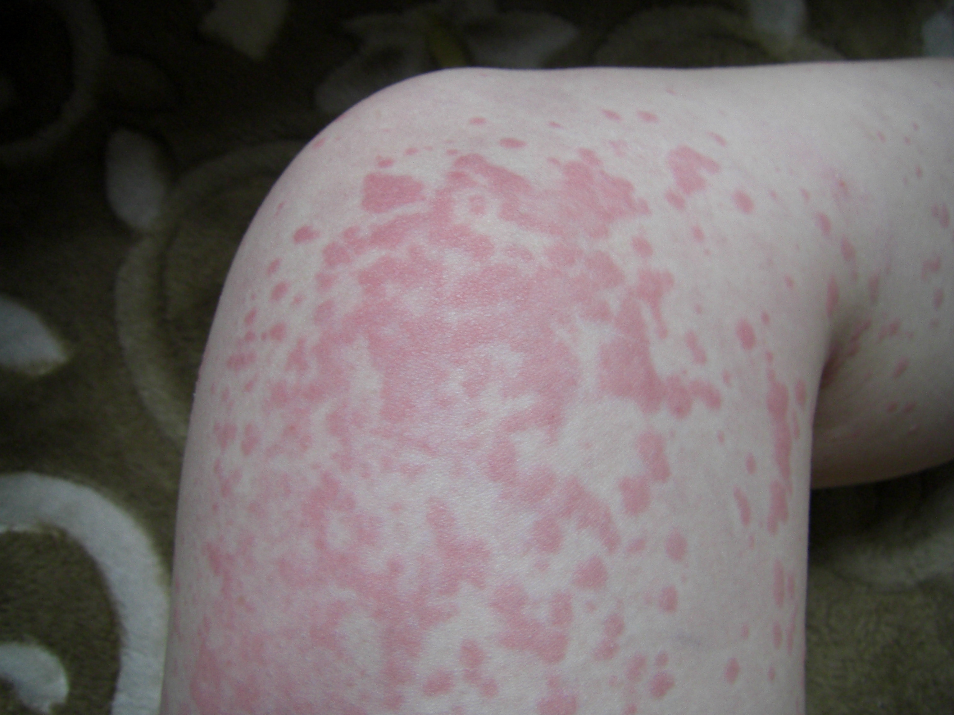 時間差攻撃 コリン性蕁麻疹