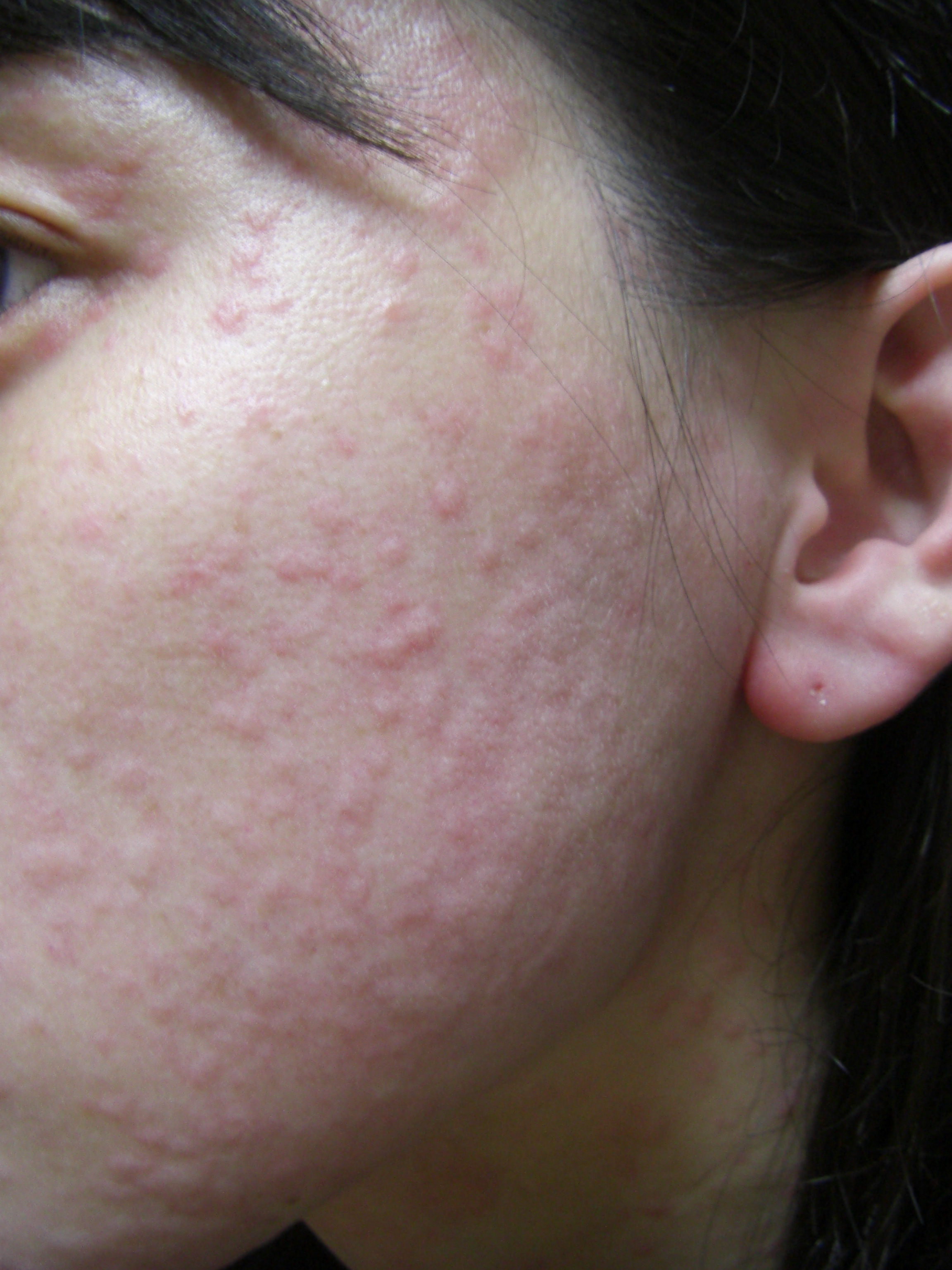 休日はうれしい コリン性蕁麻疹