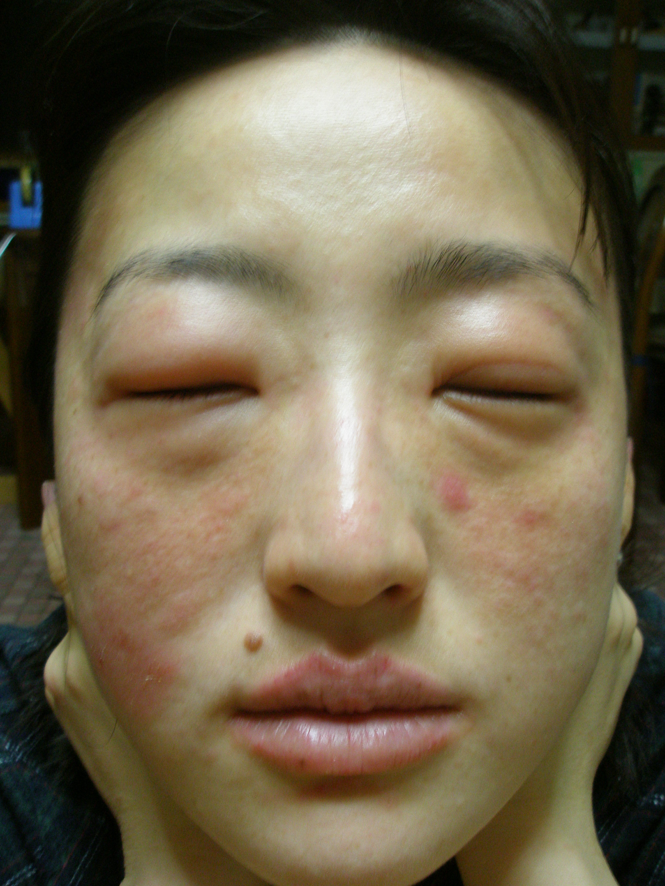 いやいや まだしんどいよ コリン性蕁麻疹