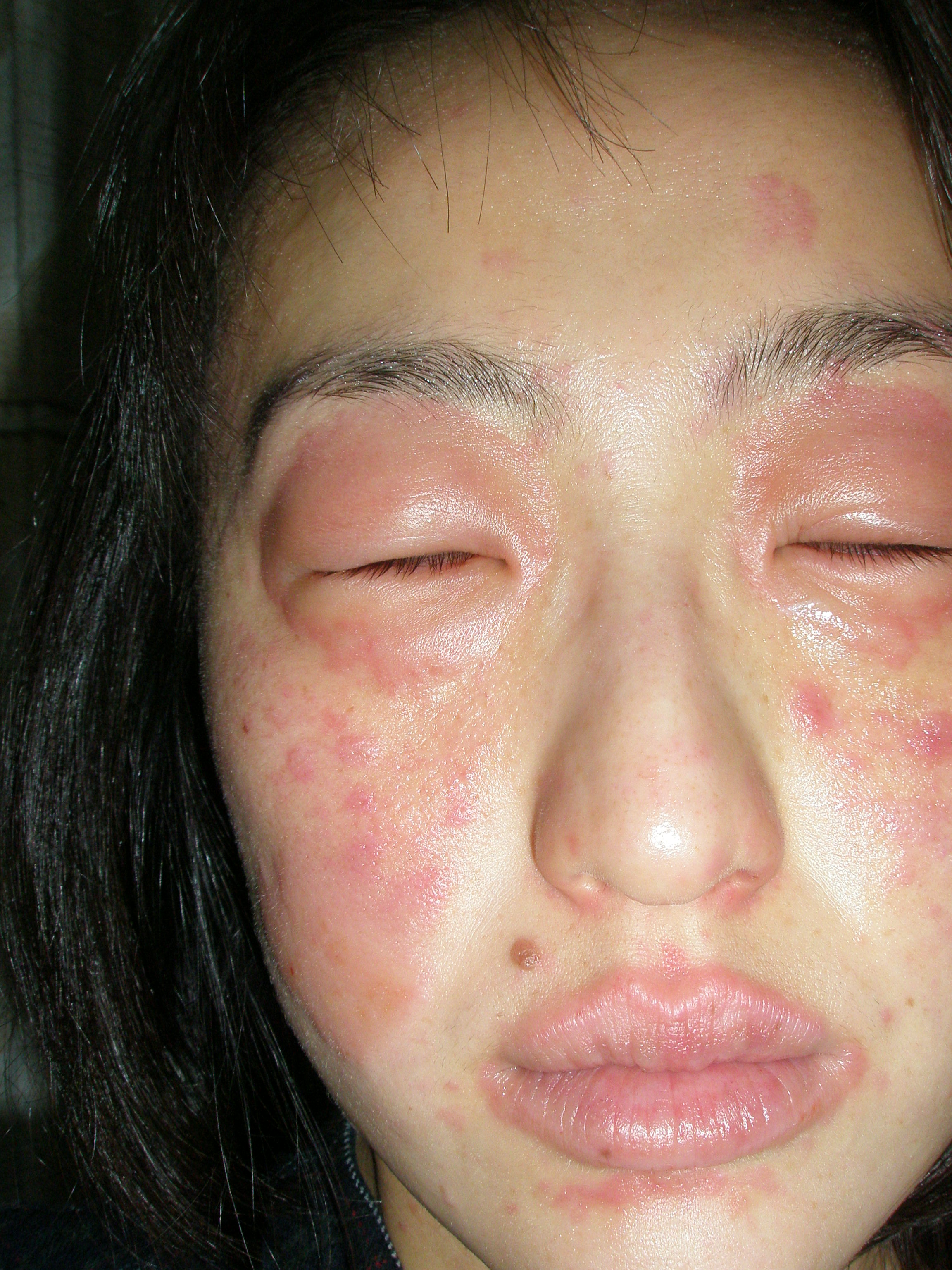 顔公開 コリン性蕁麻疹