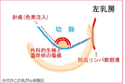 2018/12/07 手術の状況