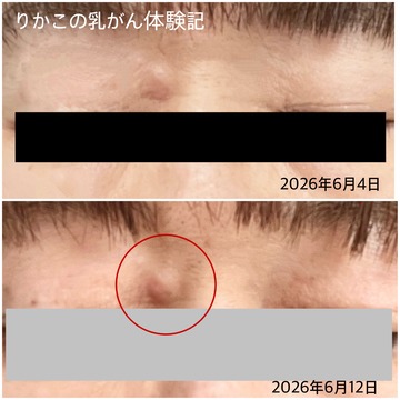 2026/06/12 腫 瘍