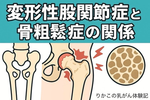 『変形性股関節症と骨粗鬆症の関係』