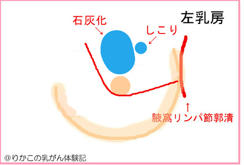 2019/12/06 マンモグラフィ検査