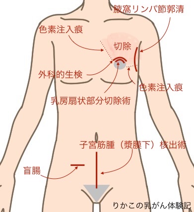 025/02/18 手術痕