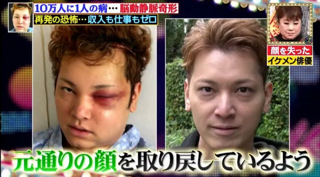 驚愕 間瀬翔太を襲った 脳動静脈奇形 って Idolland