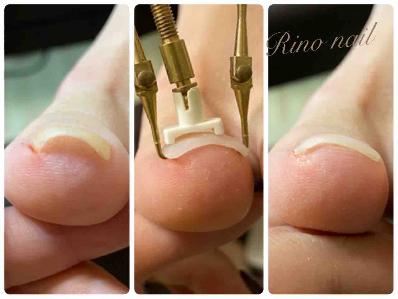 巻爪矯正 大阪梅田のネイルサロン Rino Nail のブログ