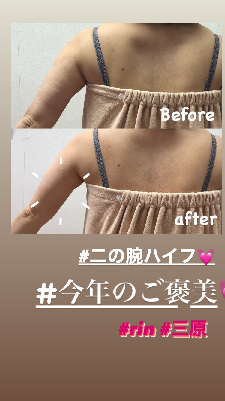 二の腕ハイフ クリニカルサロン Rin 凛 二の腕ハイフ クリニカルサロン Rin 凛
