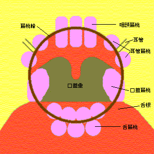tonsillarring