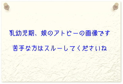 アトピーっ子情報館