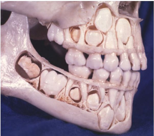 閲覧注意 歯が永久歯に入れ替わる前の子供の頭蓋骨がヤバイ ラジック