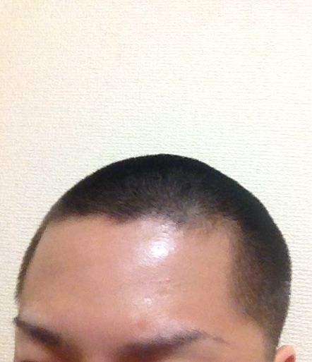 坊主にしてから五ヶ月経ったから伸びる過程を貼ってく ラジック 坊主にしてから五ヶ月経ったから伸びる過程を貼ってく ラジック