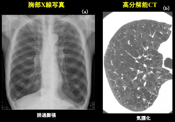 ブレブとブラと気胸 : 「走ることと生きることを綴る」一般市民ランナー兼呼吸器内科医のブログ