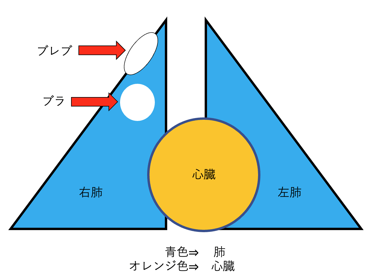 ブレブとブラと気胸 : 「走ることと生きることを綴る」一般市民ランナー兼呼吸器内科医のブログ