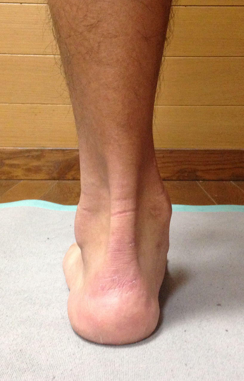 アキレス腱炎を引き起こす３つの原因と改善法 マラソン ランニング中のふくらはぎの痛み Runart ランナート足の治療院ブログ