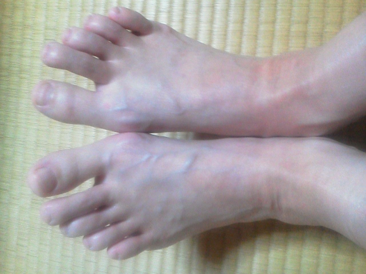 外反母趾術後半年の足 外反母趾手術ブログ