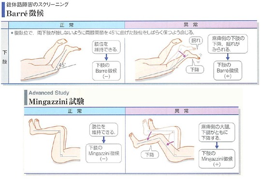 下位運動ニューロン