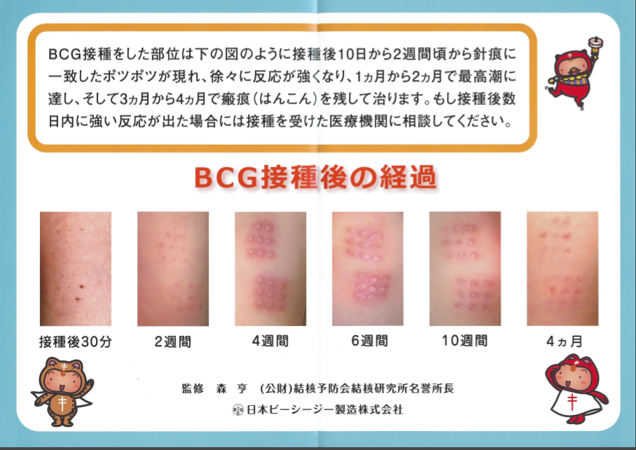 ｂｃｇ 日本型bcgで新型コロナの免疫ができる g接種を義務づけている国は例外なく死亡率が低い 芸能ニュース365