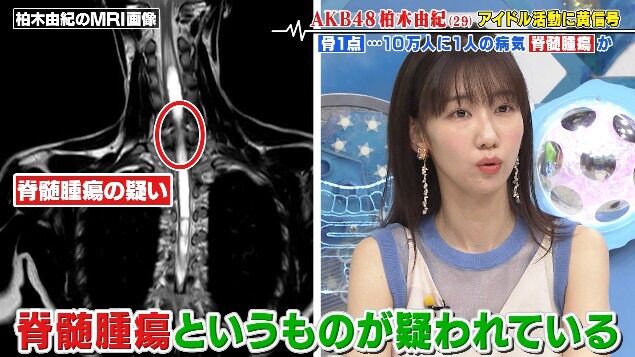 【悲報】アキバ柏木由紀さん、難病に罹患