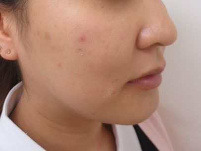 ほとんど腫れない顔やせクイックの効果は如何ほど 品川美容外科梅田院院長 Dr 坂野のブログ ほとんど腫れない顔やせクイックの効果は如何ほど 品川美容外科梅田院院長 Dr 坂野のブログ