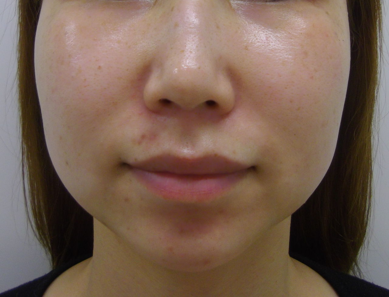 頬 頬骨上 アゴ下のベイザー 品川美容外科梅田院院長 Dr 坂野のブログ