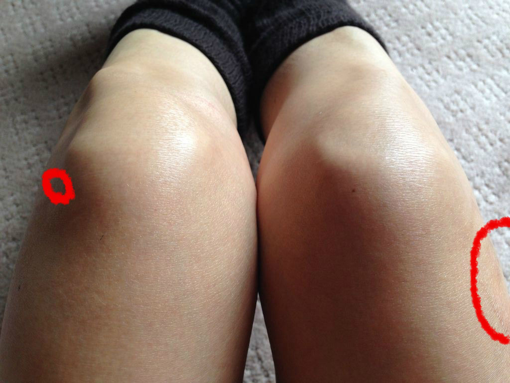 変形性膝関節症 １ 発症 楽しい一日