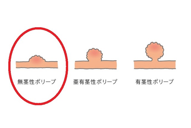 large-intestine_02_kv - コピー (2)