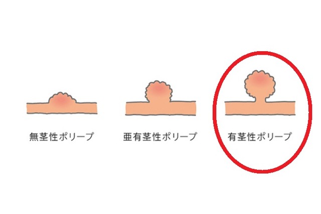 large-intestine_02_kv - コピー