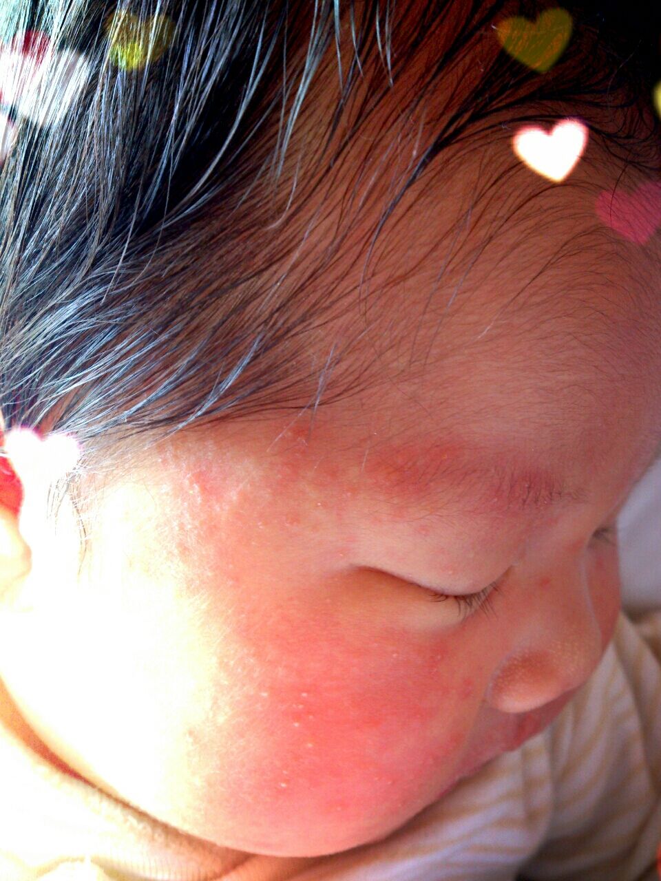 生後28日目の乳児湿疹 Sakuraのダメ人間ママ日誌