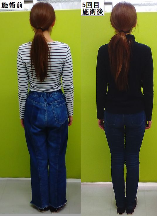 ブライダルエステだけでは取れない背中の肉 猫背矯正してみませんか 津山市の猫背矯正専門整体 産後骨盤矯正 猫背 小顔 作楽 さくら 整体院 公式ブログ 岡山県津山市