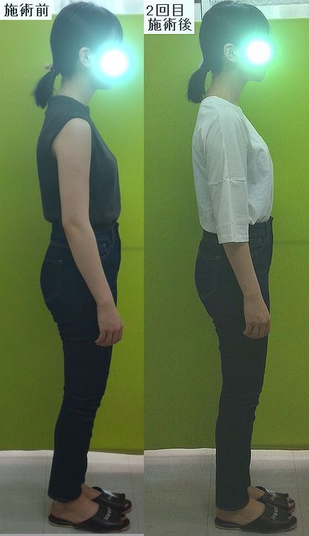 スリムな方こそ猫背矯正 ダイエットを始める前に姿勢矯正しませんか 津山市の全身矯正整体院 産後骨盤矯正 猫背 小顔 作楽 さくら 整体院 公式ブログ 岡山県津山市