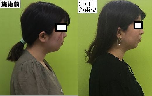 湿度でお顔むくんでませんか 作楽整体院の小顔施術でスッキリフェイス取り戻しましょう 津山市の小顔整体 産後骨盤矯正 猫背 小顔 作楽 さくら 整体院 公式ブログ 岡山県津山市